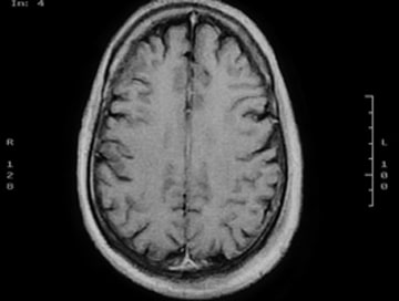 Brain Injury Lawyer