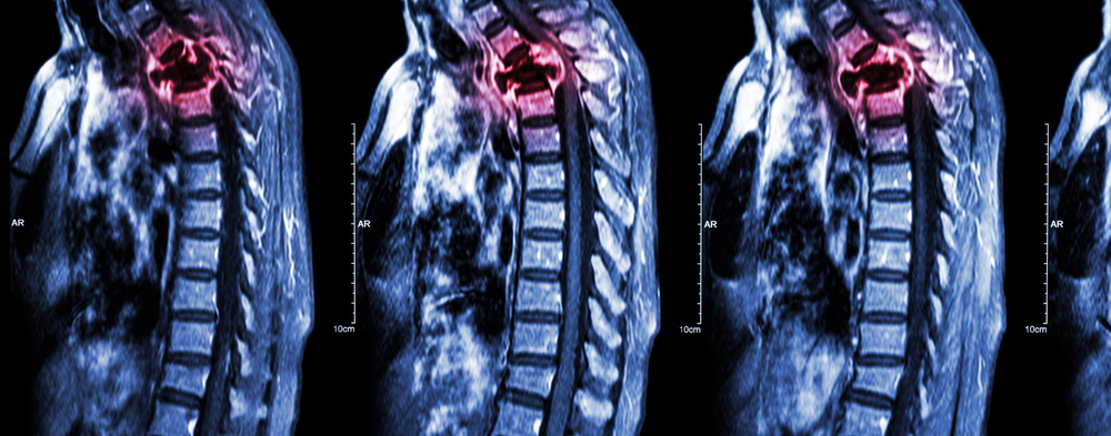 Bakersfield Spinal Cord Injury Lawyer